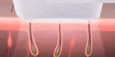 Épilateur à Lumière Pulsée Intense Ipl 999 Flashs Visage